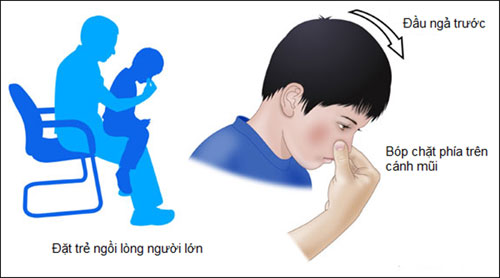 Các bước sơ cứu đúng cách nên được áp dụng khi trẻ bị chảy máu cam (Ảnh: BV Nhi Trung ương).