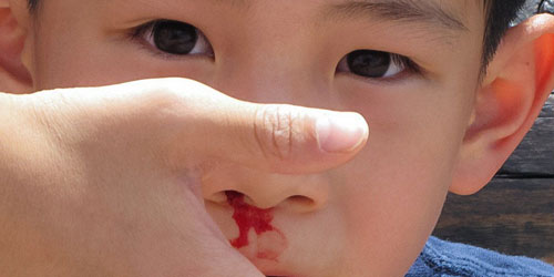 Thời tiết nóng bức những ngày hè này khiến hiện tượng chảy máu cam ở trẻ xảy ra càng nhiều.